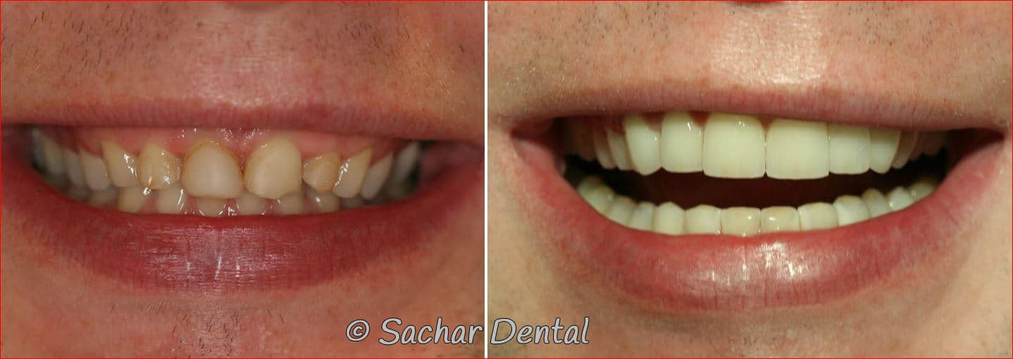 cosmetic dentist nyc crowns bondings Top NYC Cosmetic Dentists can be found at Sachar Dental