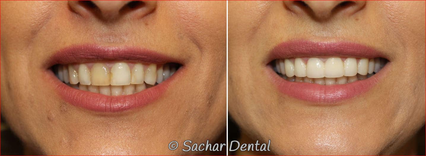 porcelain veneers crown bonding dentist nyc Top Cosmetic Dentist in New York City for Porcelain Veneers