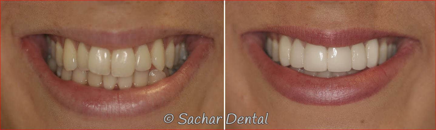 Best Dentist NYC Cosmetic Dentist NYC for Porcelain Veneers