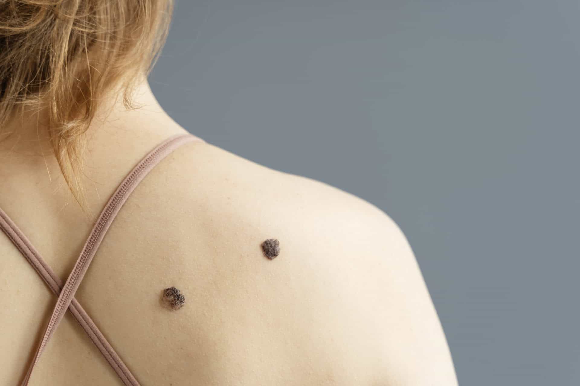 Mole Changes Colour or Shape