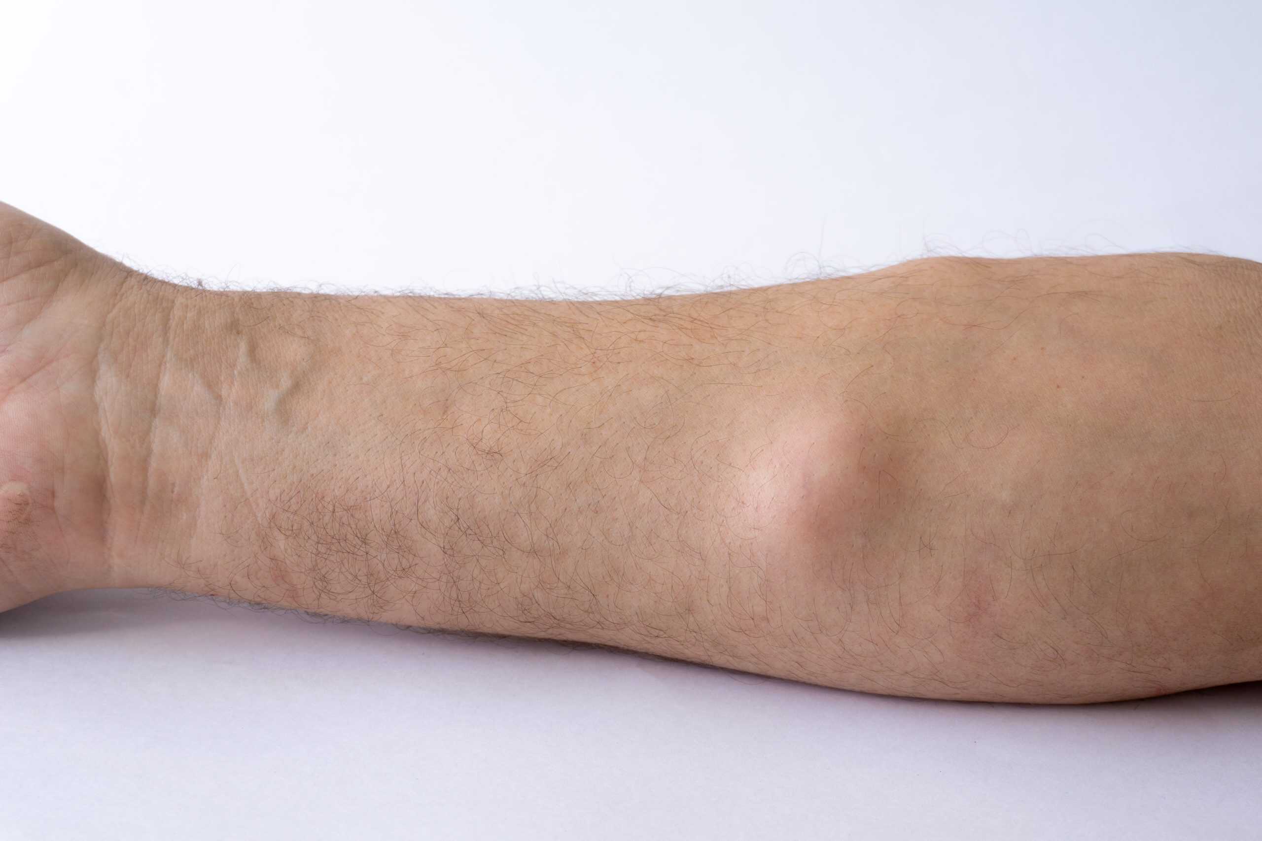 lipoma liposarcoma