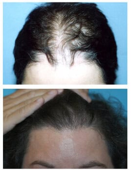 Hair Loss in Women2