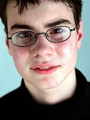 acne-vulgaris-in-teen-causes-symptoms-and-treatments