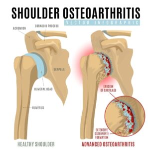 Physical therapy can help relieve pain from Shoulder Osteoarthritis Degeneration