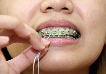 COMO QUEM USA APARELHO DEVE PASSAR FIO DENTAL