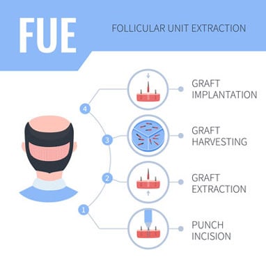 The-FUE-process