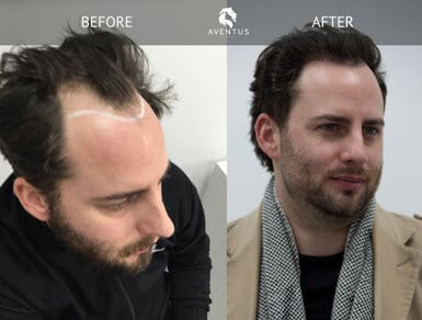Hair Loss Before after