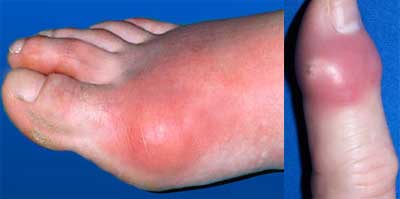 Increased-Blood-Uric-Acid-Causes-Gout-Arthritis