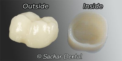 Porcelain Dental Crown Sachar Dental NYC picture of a porcelain crown