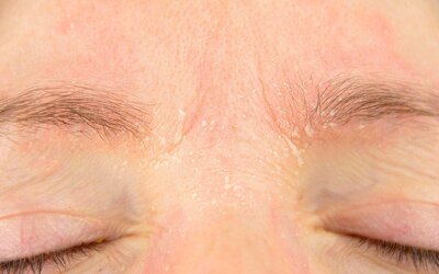 Tips And Treatments For Dermatitis On The Face