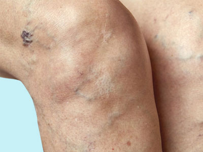 Facial-Thread-Veins
