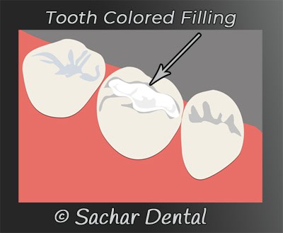 Tooth-Colored Fillings: Cavity Filling with Aesthetic Appeal