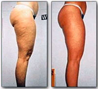 CARBOXITERAPIA ANTES E DEPOIS