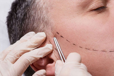 Beard-Transplant-Procedure