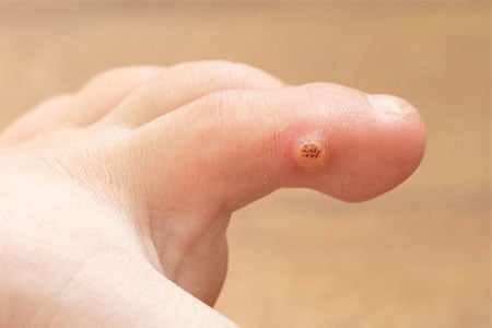 Common-Warts