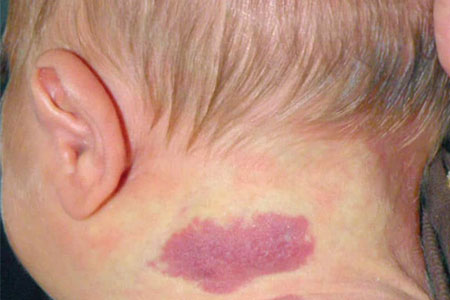 Congenital-haemangiomas