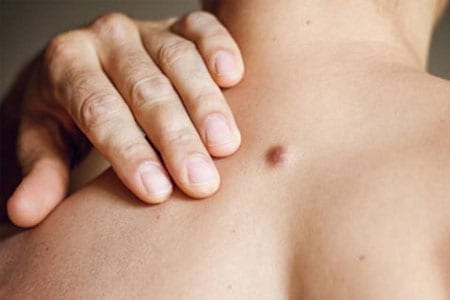 Cyst-Removal