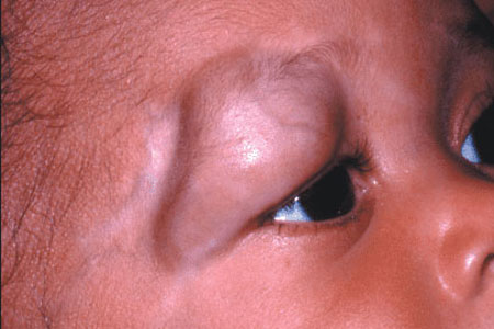 Deep-haemangiomas