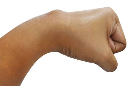 Epidermoid-Cysts