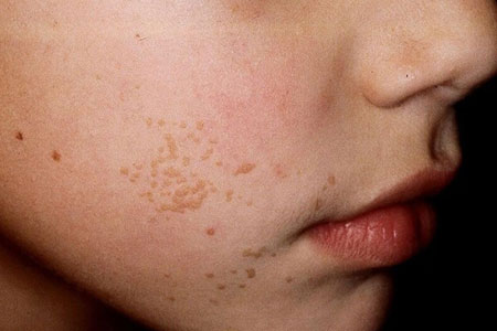 Flat-Warts