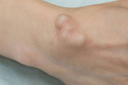 What Causes a Ganglion Cyst to Form