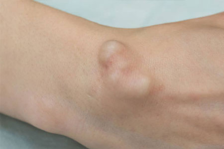 Ganglion
