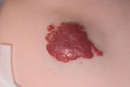 Infantile-haemangiomas