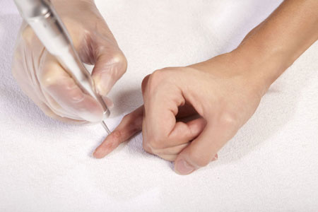 Laser-Treatment