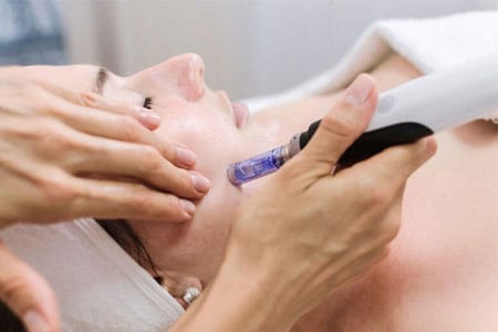Microneedling
