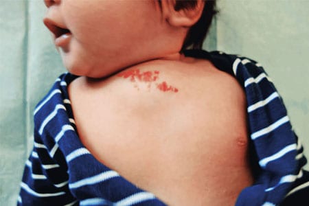 Mixed-haemangiomas