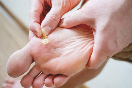 Plantar-Warts