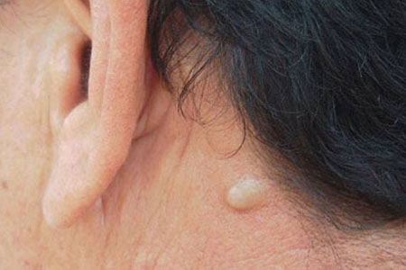 Sebaceous-Cysts