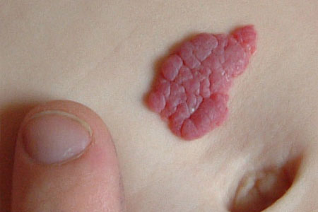 Superficial-haemangiomas