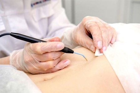 Wart-and-verruca-removal-procedure