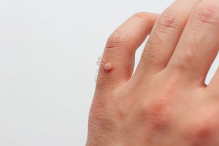Warts-and-verrucas-removal