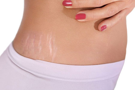 What-Are-Stretch-Marks