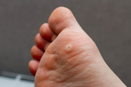 What-Are-Warts