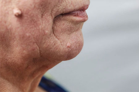 What-Ca__uses-A-Fibroma-To-Appear