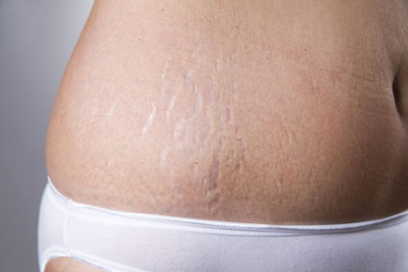 What-Causes-Stretch-Marks