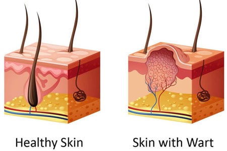 What-are-warts-and-verrucas