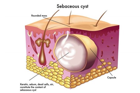 What-causes-cysts