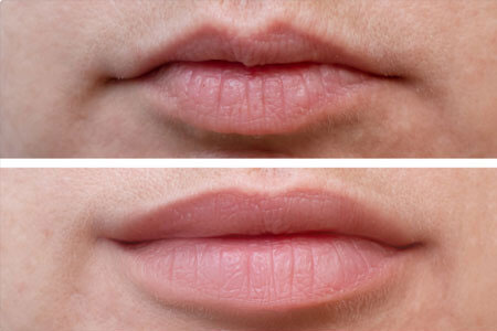 What-happens-during-a-lip-filler-treatment