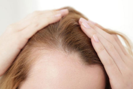 What-is-female-pattern-baldness