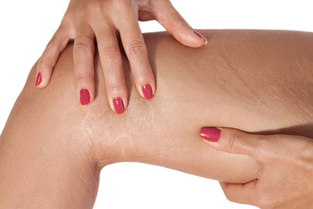 Where-Do-Stretch-Marks-Usually-Appear