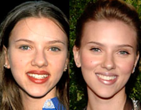 ANTES E DEPOIS - RINOPLASTIA - PLÁSTICA NO NARIZ