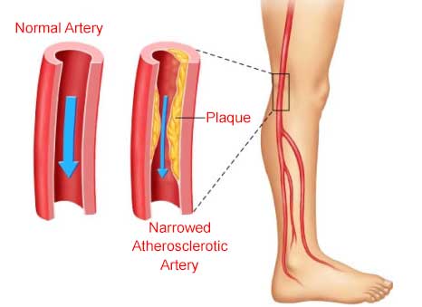 Peripheral-Artery-Disease