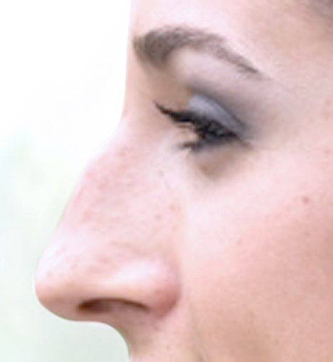 rinoplastia-antes