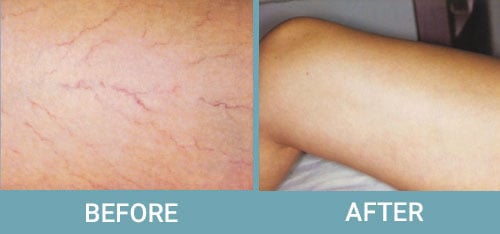 Facial-Thread-Vein-Removal-before-after