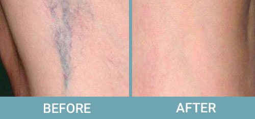 Facial-Thread-Vein-Removal-before-after1