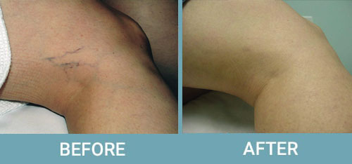 Facial-Thread-Vein-Removal-before-after2